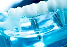 Close-up of dental implants in Bartlesville in plastic tray