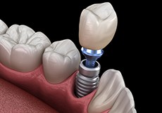 Single dental implant in Bartlesville in lower arch